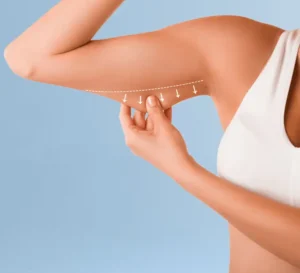 Liposuccion-des-bras liposuccion des bras Tunisie