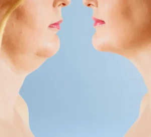 Liposuccion-du-double-menton liposuccion de double menton Tunisie