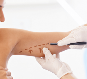 lifting-des-bras-ou-brachioplastie brachioplastie Tunisie