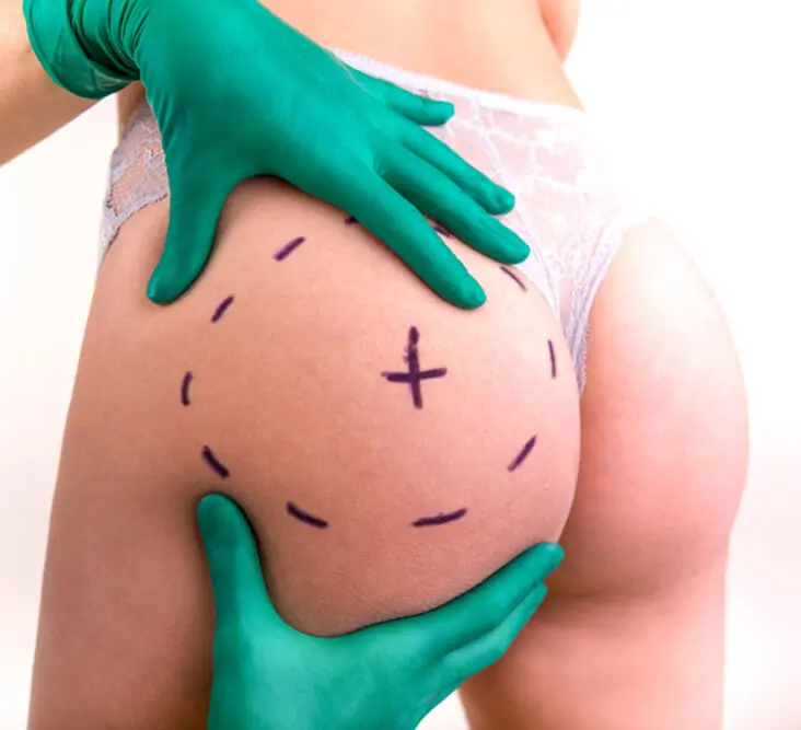 lipofilling fessieren Tunisie