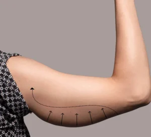 liposuccion bras tunisie