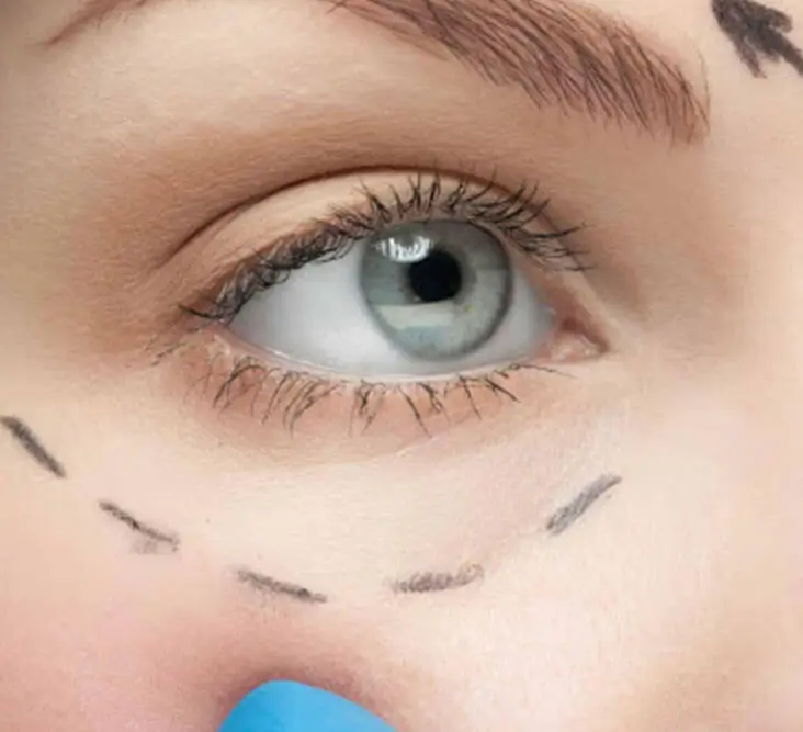 Blépharoplastie Tunisie : Lifting des paupières