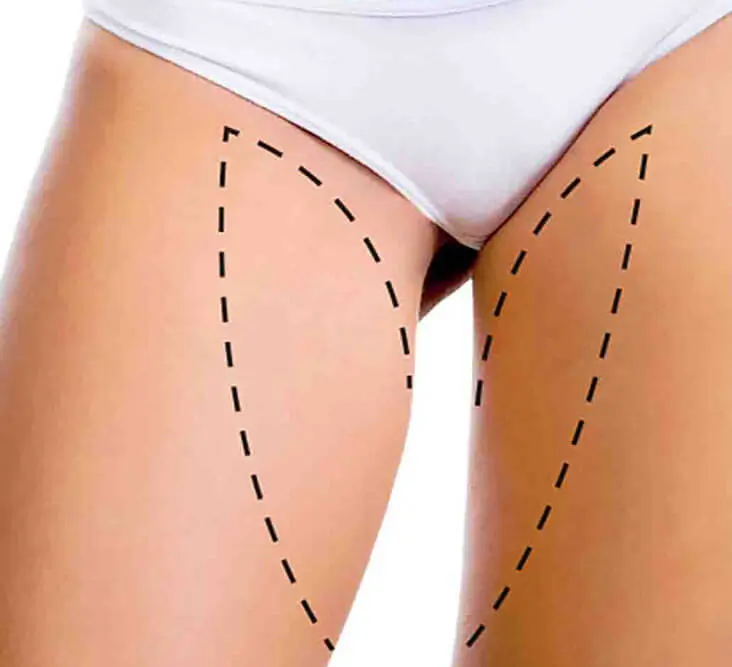 lifting des cuisses Tunisie